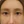 Full-face filler (full-face HA rejuvenation) — before · Project U Clinic