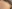 額縮小術（生え際下げ・ヘアライン下降術） — ザフィックス美容外科クリニック