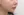 ตัดไขมันกระพุ้งแก้ม — ก่อนทำ (9วัน) · ไอรูมิ ศัลยกรรมพลาสติก