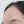 PRP skin rejuvenation (platelet-rich plasma therapy) — before · U&Me Clinic