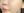 skin booster injection (water glow injection) — after (5days) · Nowon ID Clinic