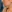 jaw angle reduction (mandibular angle osteotomy) — Uri Plastic Surgery Clinic