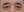 lower blepharoplasty (under-eye bag removal with fat repositioning) — before (7days) · Custom Plastic Surgery Clinic