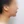 下巴異物取出（下巴假體移除） — 術後 (30天) · Returning醫美診所