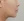 Accent Prime 電波音波拉提（Alma 艾森電熱刀系統） — 術後 (14天) · ID醫院-皮膚科