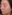 revision rhinoplasty — Coco Line Clinic
