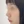 Nose tip filler — after · Erne Clinic