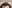 生え際の植毛（ヘアライン植毛） — バンスモザイナークリニック