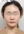 two-jaw surgery (bimaxillary orthognathic surgery) — after (90days) · A-Top Plastic Surgery Clinic