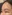 Ptosis Correction (levator surgery / eye-shape correction) — Thank You Plastic Surgery