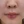 โบท็อกซ์ร่นร่องริมฝีปาก (Lip Flip ทำให้ร่องใต้จมูกดูสั้นลง) — หลังทำ (7วัน) · คลินิก Younme