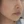 Surfect Lifting (4MHz monopolar RF lifting) — before (7days) · Only Lift Clinic