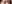 切開法（全切開法二重術） — フルルン美容外科クリニック