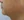 Surfect Lifting (4MHz monopolar RF lifting) — after (7days) · Le Shine Clinic
