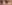 裏ハムラ法（経結膜的眼窩脂肪移動術） — ウィバース美容外科クリニック