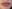 Lip filler (lip augmentation with HA) — Wow Plastic Surgery
