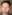 Platysma plication (corset platysmaplasty for double chin/jawline) — Shinsang Plastic Surgery Clinic