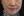 Oligio / Oligio X (โอลิจิโอ) — ก่อนทำ (30วัน) · เยพึนออลกุลคลินิก