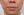 JUVGEN (autologous dermal regeneration / collagen-induction injection) — before (14days) · Saeroun Plastic Surgery