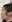 Bulbous nose correction (surgical nasal tip reduction) — Eight Plastic Surgery Clinic