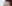 額縮小術（生え際下げ・ヘアライン下降術） — ララ美容外科クリニック