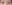 Ptosis Correction (levator surgery / eye-shape correction) — Uri Plastic Surgery Clinic