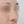 ผ่าตัดแก้ไขผนังกั้นช่องจมูกคด (Septoplasty) — หลังทำ (14วัน) · คลินิกศัลยกรรมพลาสติ์ พาดา