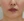 Botox for nasolabial folds — before (8days) · VS Line Clinic - Incheon Guwol Branch