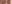 切開法（全切開法二重術） — Unique Plastic Surgery Clinic