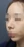 revision rhinoplasty — before (7days) · Anersty Plastic Surgery Clinic