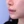 ศัลยกรรมยกริมฝีปากบน (Lip Lift) — หลังทำ (7วัน) · ไฮบอม ศัลยกรรมพลาสติก