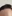 額縮小術（生え際下げ・ヘアライン下降術） — ヒート美容外科クリニック