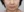 ฟิลเลอร์ร่องน้ำหมาก (ร่องมุมปาก) — ก่อนทำ (105วัน) · คลินิกเสริมความงามเทรนดี้