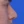 ผ่าตัดแก้ไขผนังกั้นช่องจมูกคด (Septoplasty) — หลังทำ (14วัน) · คลินิกโคบิจู