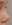 Revision Rhinoplasty with Silicone Implant Removal — Olive Plastic Surgery Clinic