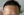 ปลูกผมบริเวณจอน — หลังทำ (365วัน) · คลินิกเสริมความงามเชียงดัมโอเค