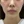 Belotero Revive (HA + glycerol skinbooster) — before (30days) · AB Plastic Surgery & Skin Clinic