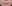 人中短縮（リップリフト） — ハイボム美容外科クリニック