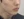 ฉีดสเต็มเซลล์ (Stem cell injection) — ก่อนทำ (30วัน) · คลินิก AB Aesthetic Surgery