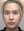 ฉีดสลายไขมันหน้า (เมโสแฟตแก้ม) — หลังทำ · คลินิกท็อกซ์แอนด์ฟิล สาขาชินนอนฮยอน