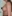 Breast augmentation with implants — Uri Plastic Surgery Clinic
