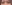 裏ハムラ法（経結膜的眼窩脂肪移動術） — ファクト美容外科クリニック