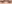 二重まぶた（自然癒着法） — アーバン美容外科クリニック