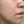 Rejuran S (รีจูรัน S กล่องน้ำเงิน — หลุมสิว/แผลเป็น) — ก่อนทำ (14วัน) · คลินิก U