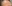 額（おでこ）のシワ ボトックス注射 — チャ・ミン美容外科クリニック