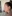 Double chin liposuction (submental liposuction) — Seoul During Clinic