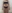 Arm liposuction — Le Rose Clinic