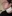 Double chin liposuction (submental liposuction) — Shinsang Plastic Surgery Clinic