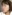 オトガイ骨削り（あご先の縮小術） — ハイエンド美容外科クリニック