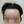 Hairline hair transplant (hairline lowering by grafting) — before (1days) · Vance Mosae Clinic